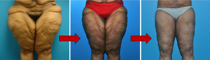 Comprehensive Treatment for Lipedema: What You Can Do 