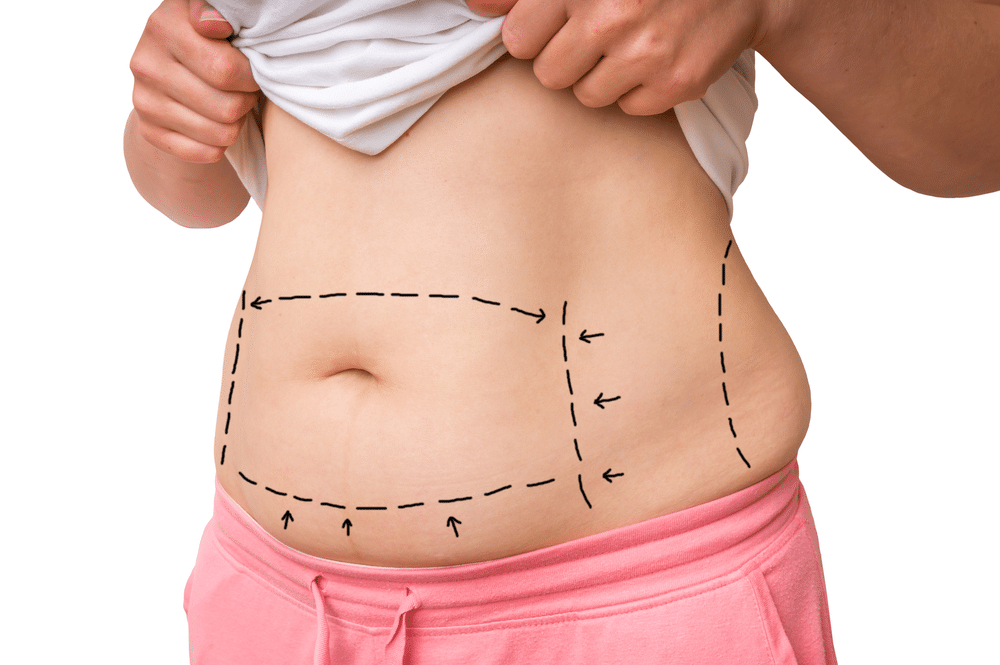 How Much Is a Tummy Tuck in Chicago?