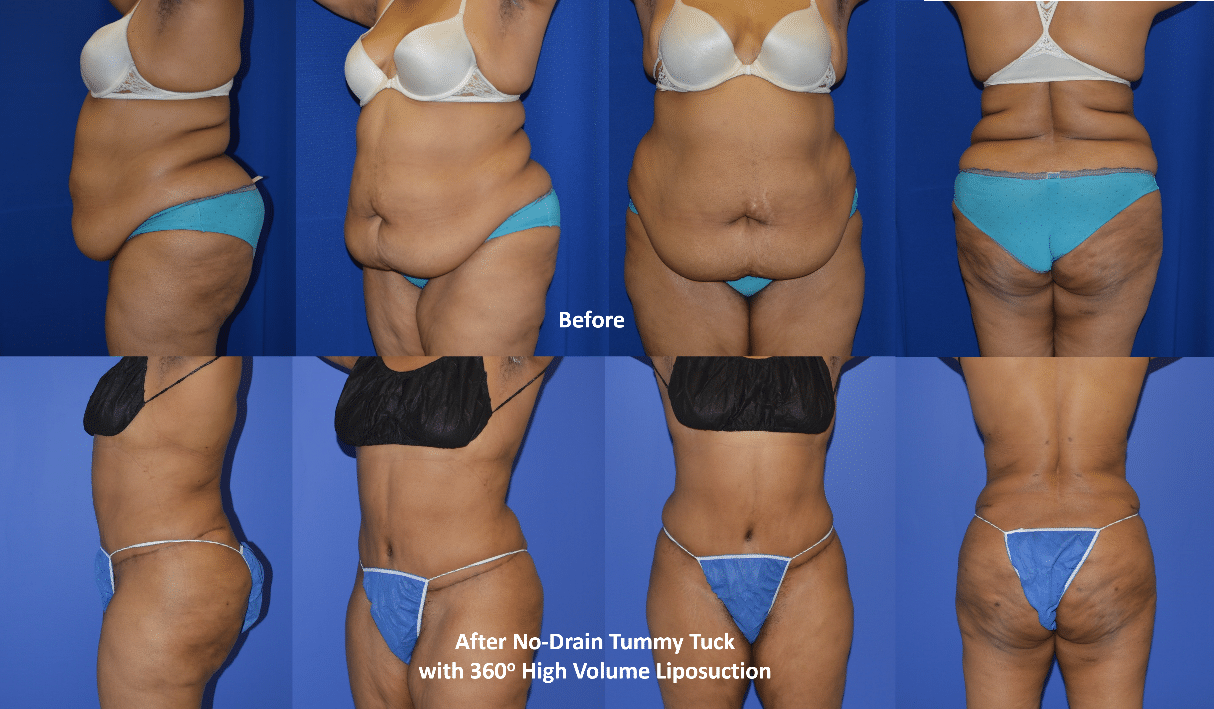 Can Liposuction be Safely Combined with Abdominoplasty?