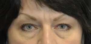 Eyelid Surgery Before and After 